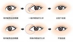北京韩式微创开眼角价格大概多少