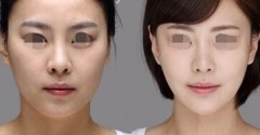 颧骨缩小后脸会变小吗