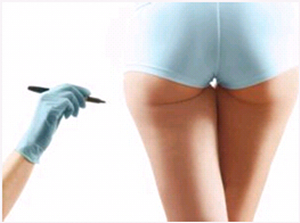 臀部,吸脂,减肥,价格,是多少