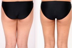 大腿吸脂减肥的原理是什么