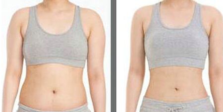 局部吸脂手术后会反弹吗