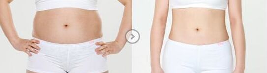 做腰腹部吸脂手术会影响生育吗