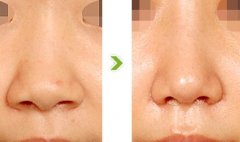 鼻翼缩小哪些人适合做 鼻翼缩小哪些人适合做
