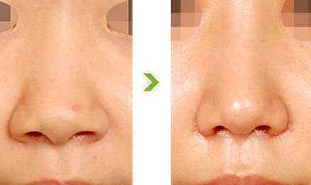 鼻翼缩小哪些人适合做