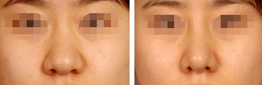 鼻翼缩小有哪几种方法