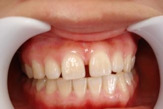 补牙缝,一般,需要,多少钱