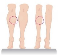 腰腹吸脂大概多少钱