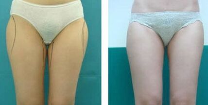 腿部吸脂后多久能上班