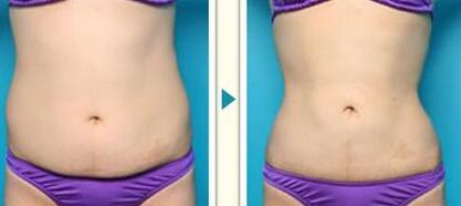 腰腹部吸脂手术降低风险吗