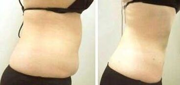 腹部吸脂减肥的价格多少