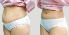 腰腹吸脂手术后会不会留疤