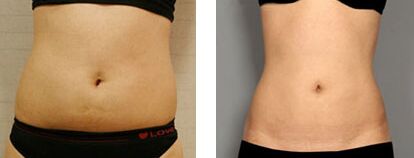 腹部吸脂都适合哪些人