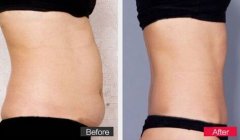 腰腹吸脂手术不适合哪些人