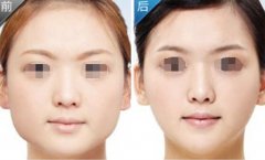 吸脂瘦脸的果是永.久的吗