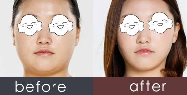 婴儿肥的人可以做面部吸脂吗
