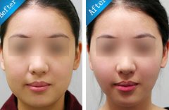 面部吸脂瘦脸果怎么样