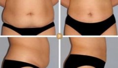 腹部吸脂手术有副作用吗