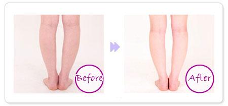 什么是,吸脂减肥,会影响健康吗