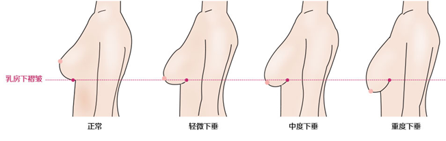 女性,胸部下垂,应该,怎么办