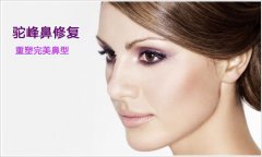 什么是驼峰鼻 驼峰鼻该怎么矫正