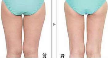 大腿内侧吸脂会不会影响内分泌