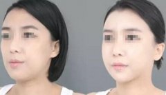 纳米自体脂肪丰脸颊有风险吗
