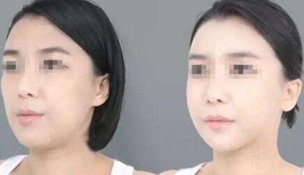 纳米自体脂肪丰脸颊有风险吗