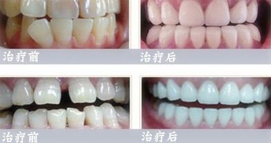 做烤瓷牙有什么优势