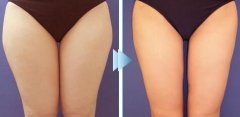 大腿吸脂手术多久恢复自然
