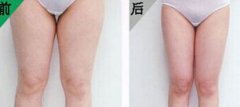 哪些人适合做大腿吸脂
