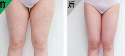 哪些人适合做大腿吸脂