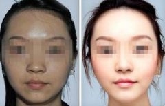 激光美白果持续多久