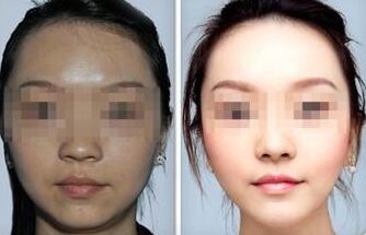 激光美白果持续多久