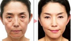 电波l皮后多久能够恢复