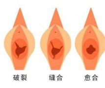 处女膜再造术后一般多久可以恢复