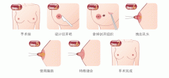 南京乳房整形多少钱