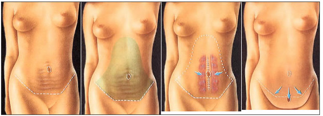 郑州,腹壁,整形,多少钱