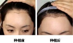 美人尖种植整形是什么 美人尖整形前后对比图片 美人尖种植整形是什么 美人尖整形前后对比图片