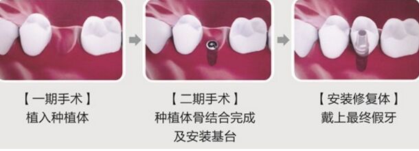 种植牙可以用多久