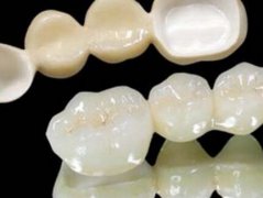 美容冠和烤瓷牙有什么区别