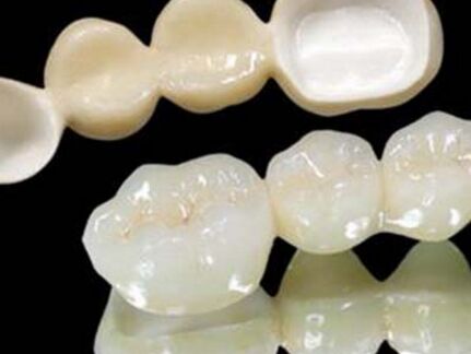 美容冠和烤瓷牙有什么区别