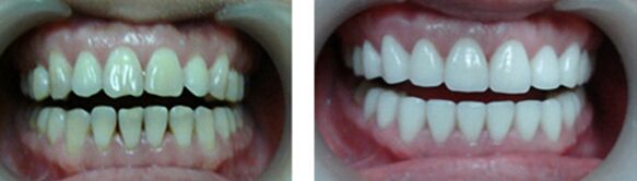 怎么延长烤瓷牙的使用寿命