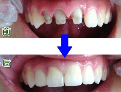 做烤瓷牙多少钱一颗