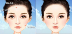 自体脂肪填充颧骨疗程需要几次 果怎么样