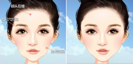 自体脂肪,填充,颧骨,疗程,需要几次,果,怎么样