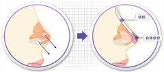 隆鼻材料对人体有害吗 隆鼻材料对人体有害吗