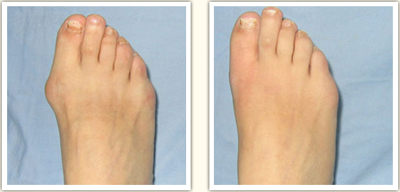 长春,大脚骨,矫正,多少钱