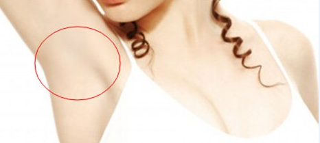 广州,微创,去除腋臭,多少钱