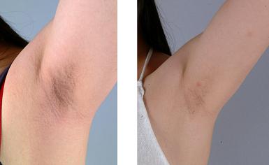 宁波做冰点疼痛感较轻脱毛要多少钱