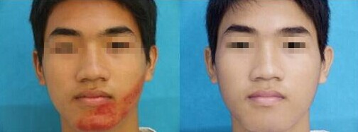 宁波做激光祛胎记需要多少钱